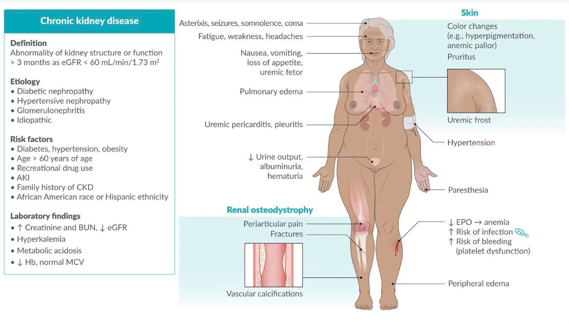 AMBOSS illustration of chronic kidney disease