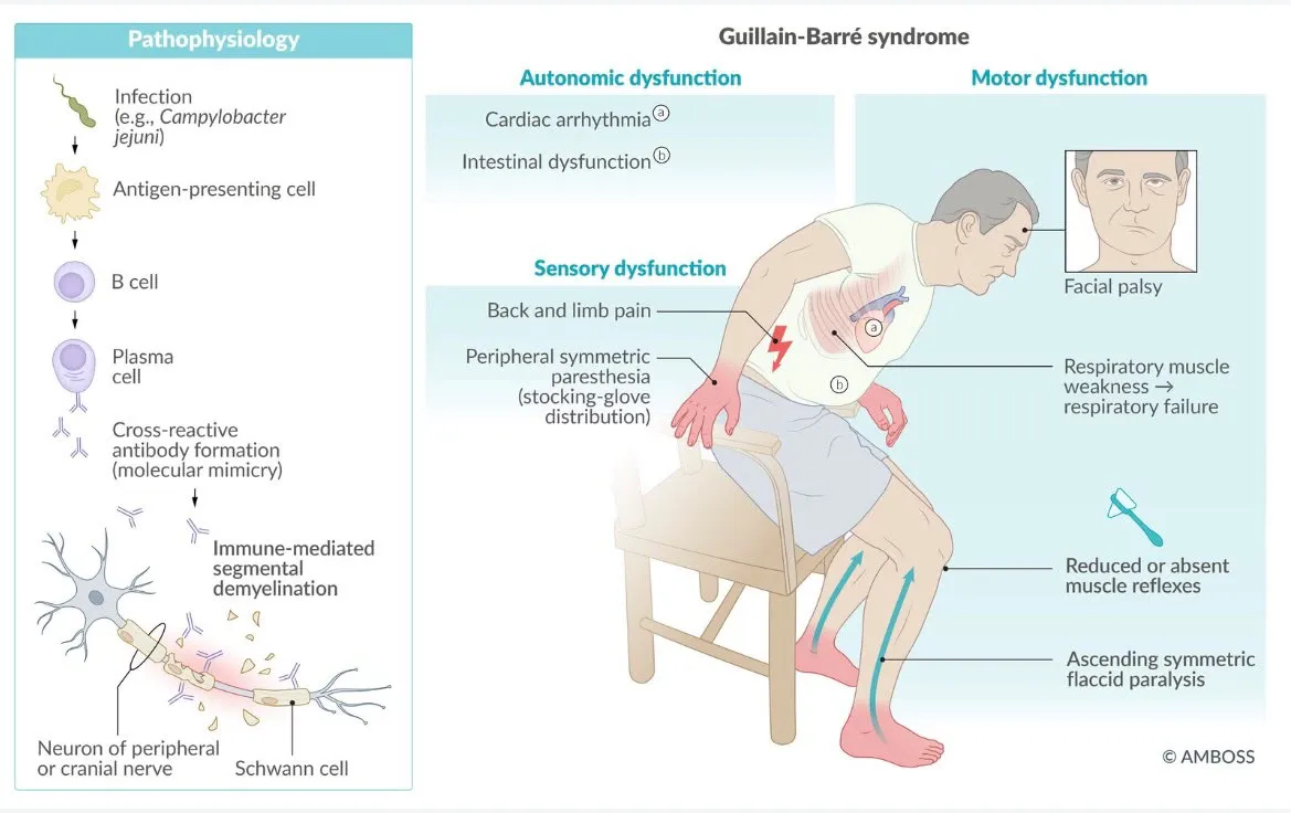 AMBOSS illustration of Guillain-Barré syndrome