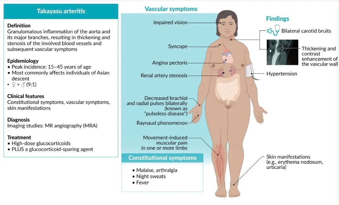 AMBOSS illustration of Takayasu arteritis