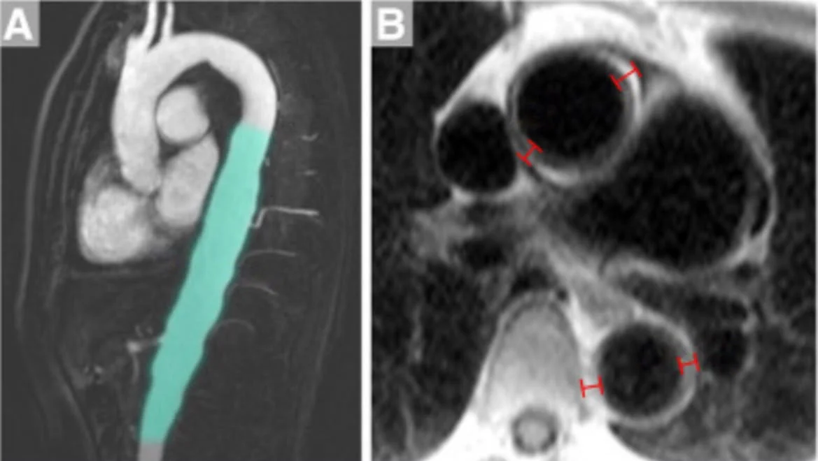 The same MRI with the AMBOSS overlay marking the thickened aortic wall