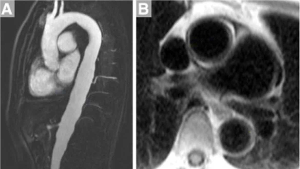 MRI of Takayasu arteritis without annotation